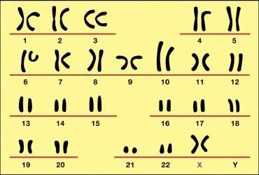 The female with this karyotype would have which genetic disorder? a. klinefelter's syndrome b. turn