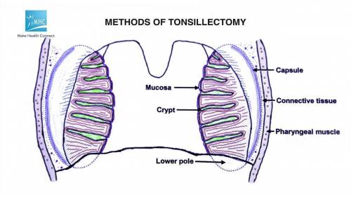 Tonsillar crypts are invaginations deep into the interior of the tonsil. what structure(s), found in