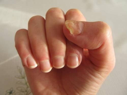 What disease is nick suffering from?  nick observes thickening and discoloration of the nail of the