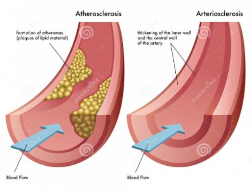 Compare and contrast arteriosclerosis with atherosclerosis.