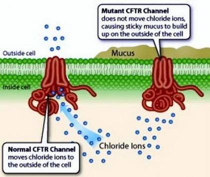 The most commonly occurring mutation in people with cystic fibrosis is a deletion of a single codon.