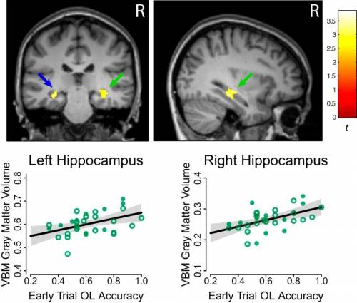 Damage to the  is most likely to interfere with explicit memories of newly learnedverbal information