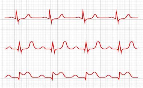 What type of data is recorded by the electrocardiogram? A. the amount of oxygen in the blood B. the