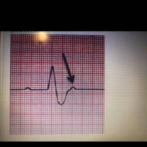 Which statement described the condition of the heart at the point indicated in the electrocardiogra