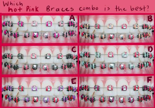 Which Hot Pink braces color combo is the best!? Getting the most popular! (20 points!)

A: Light p
