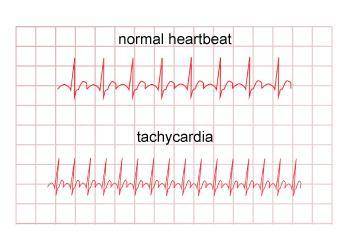 The image shows EKGs of a person with normal heart waves and of a person having tachycardia. Based