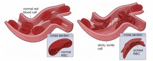 WILL GIVE BRAINLIEST

Sickle-shaped red blood cells carry less oxygen than healthy cells. What is
