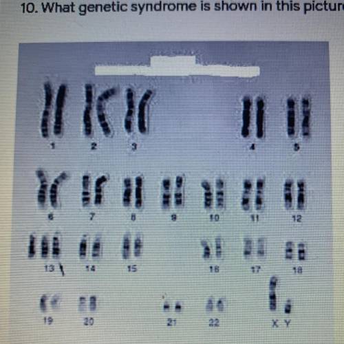 10. What genetic syndrome is shown in this picture?