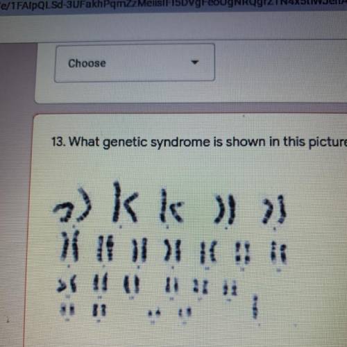 13. What genetic syndrome is shown in this picture? *