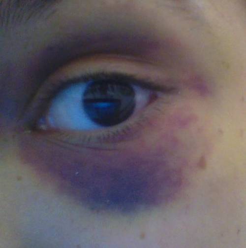 Ummm guys? i kind have a black eye and i need help.

does anyone know how i can heal it please?