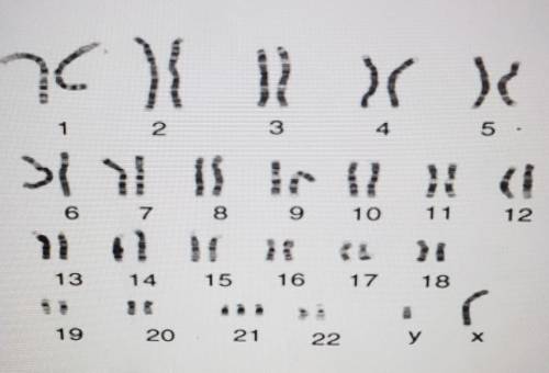The person whose karyotype is shown below has which disorder?

trisomy 21trisomy 22trisomy 23a sex