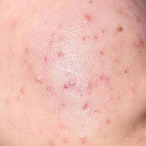 Can someone tell me what acne I have? And maybe how to treat it