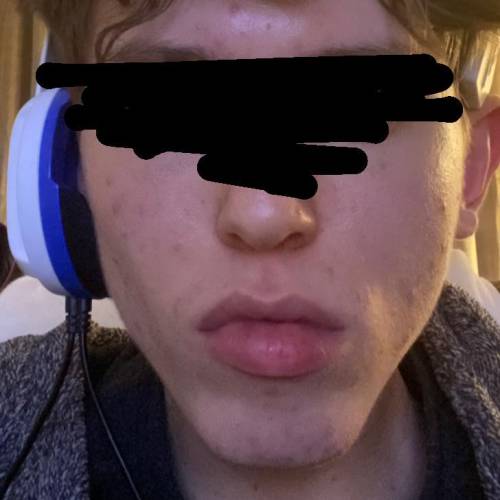 ￼Why is one side of my jaw bigger/puffier then the other, and how can i fix it